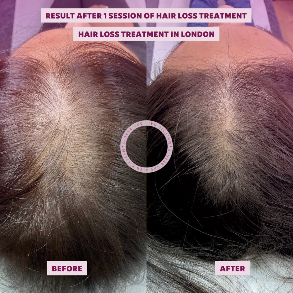 Hair loss treatment in london before and after