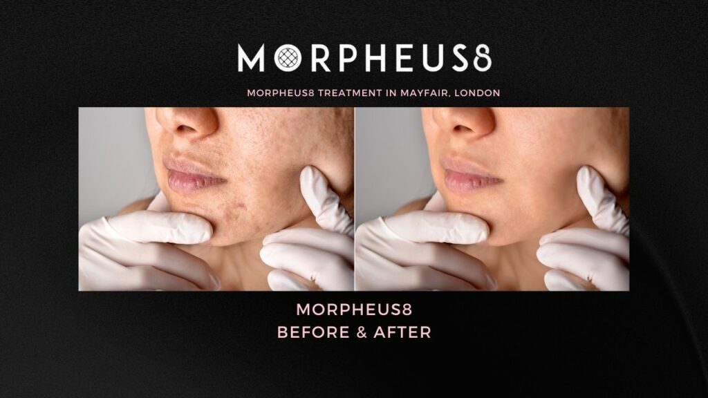 morpheus8 before and after