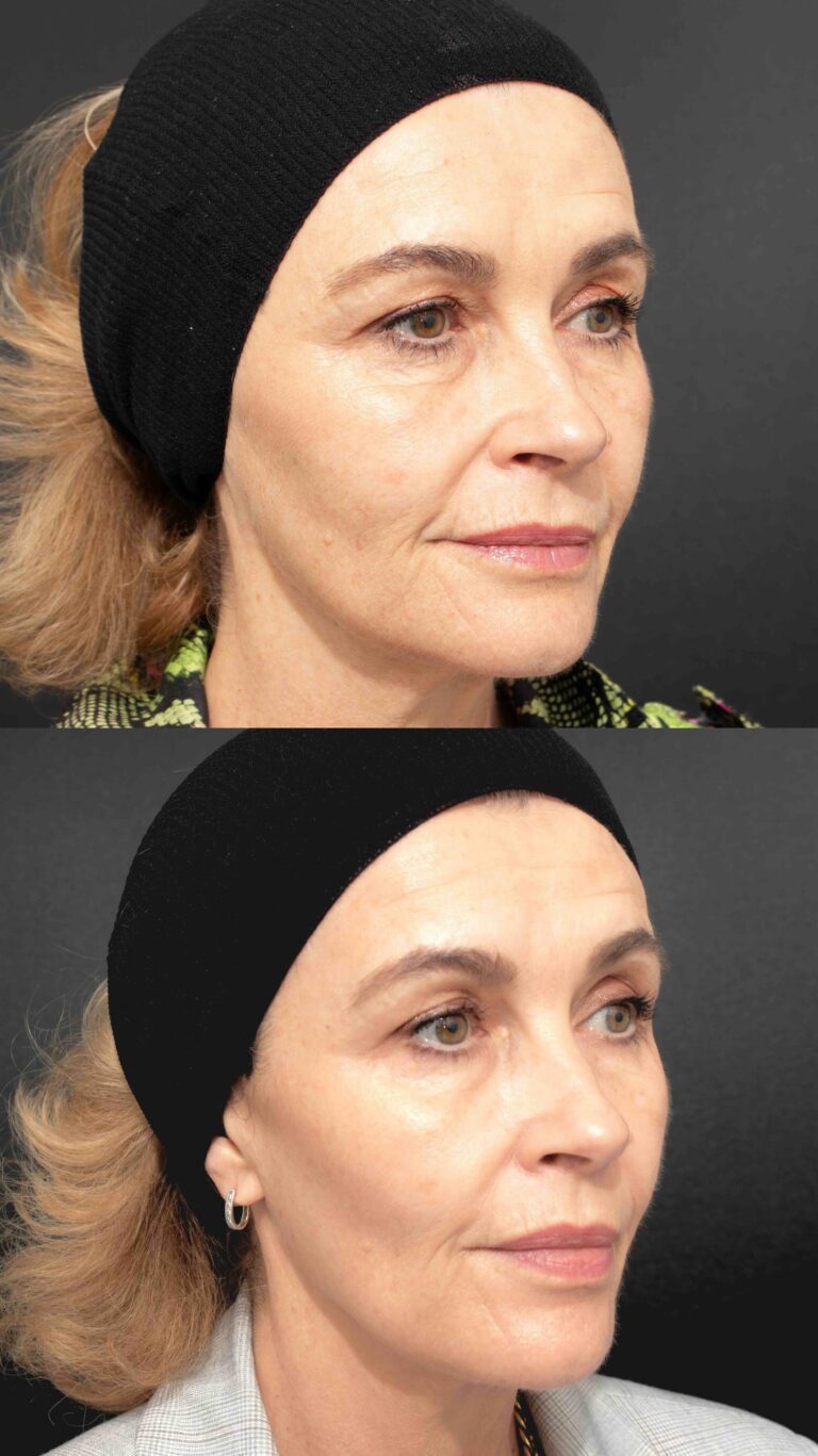 Profhilo Treatment