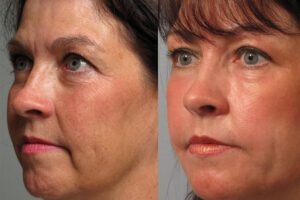 Profhilo Treatment