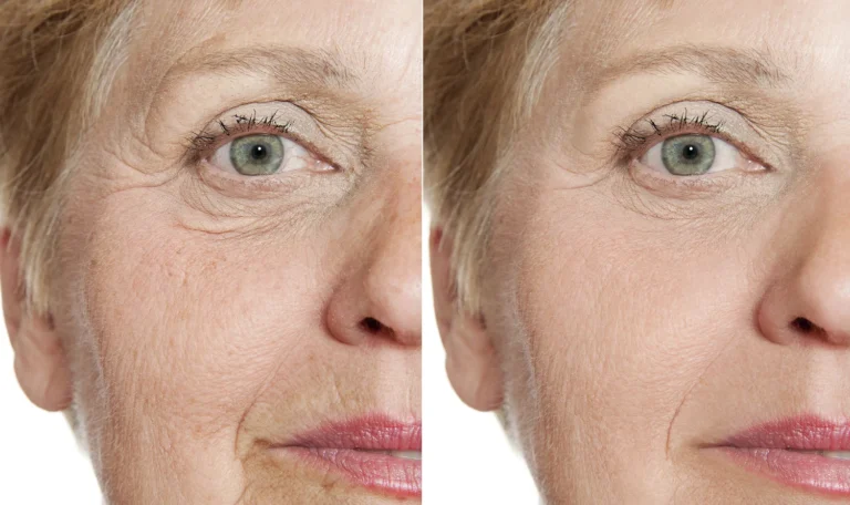Profhilo Treatment