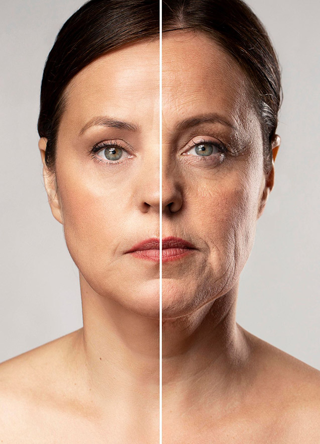 Profhilo Treatment